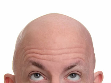 prothomalo bangla 2023 10 f534a9dc 45e5 4efa 912c 1623411d683b web baldness bald RF istock